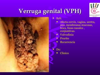 Verruga genital (VPH) SyS: Afecta cervix, vagina, uretra, ano, membranas mucosas, boca, fosas nasales , conjuntivas. Vulvodinia Prurito Recurrencia Dx: Clinico 