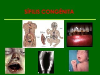 SÍFILIS CONGÉNITA
 