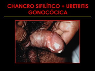 CHANCRO SIFILÍTICO + URETRITIS
     GONOCÓCICA
 