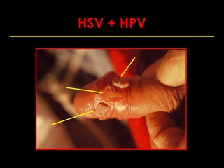 HSV + HPV
 