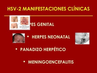 HSV-2 MANIFESTACIONES CLÍNICAS


    HERPES GENITAL

        HERPES NEONATAL

   PANADIZO HERPÉTICO

      MENINGOENCEFALITIS
 