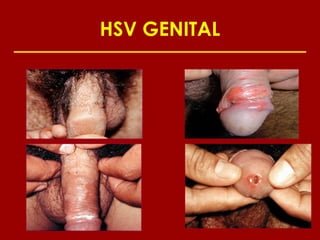 HSV GENITAL
 
