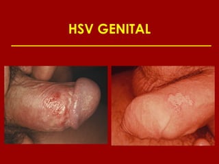 HSV GENITAL
 