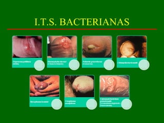 I.T.S. BACTERIANAS
 