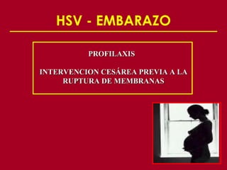 HSV - EMBARAZO

          PROFILAXIS

INTERVENCION CESÁREA PREVIA A LA
     RUPTURA DE MEMBRANAS
 