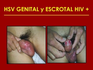 HSV GENITAL y ESCROTAL HIV +
 