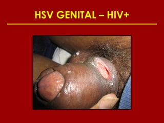 HSV GENITAL – HIV+
 