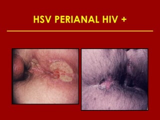 HSV PERIANAL HIV +
 