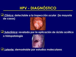 HPV - DIAGNÓSTICO
 Clínica: detectable a la inspección ocular (la mayoría
 de casos)




 Subclínica: revelada por la aplicación de ácido acético
 o histopatología




 Latente: demostrable por estudios moleculares
 