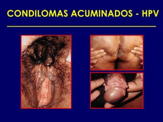CONDILOMAS ACUMINADOS - HPV
 