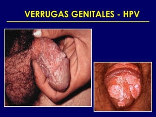 VERRUGAS GENITALES - HPV
 
