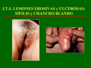 I.T.S. LESIONES EROSIVAS y ULCEROSAS:
        SÍFILIS y CHANCRO BLANDO
 