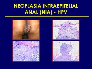 NEOPLASIA INTRAEPITELIAL
   ANAL (NIA) - HPV
 