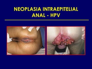 NEOPLASIA INTRAEPITELIAL
      ANAL - HPV
 