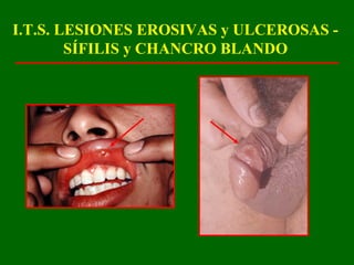 I.T.S. LESIONES EROSIVAS y ULCEROSAS -
        SÍFILIS y CHANCRO BLANDO
 