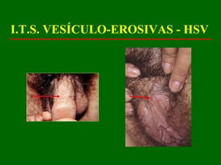 I.T.S. VESÍCULO-EROSIVAS - HSV
 
