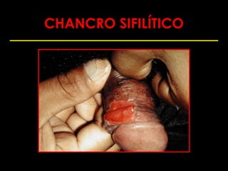 CHANCRO SIFILÍTICO
 