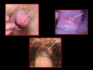 3 de cada 10 sujetos en contacto sexual con S. primaria
contraerán la enfermedad a los 30 días
 