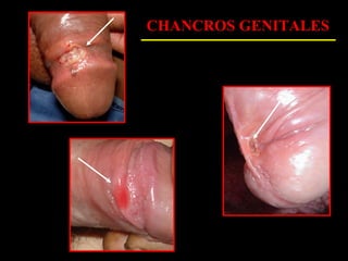 CHANCROS GENITALES
 