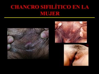 CHANCRO SIFILÍTICO EN LA
        MUJER
 
