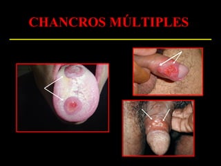 CHANCROS MÚLTIPLES
 