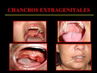 CHANCROS EXTRAGENITALES
 
