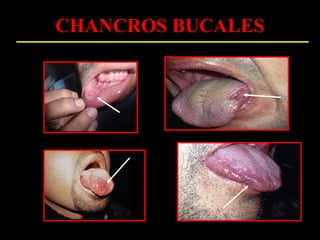 CHANCROS BUCALES
 