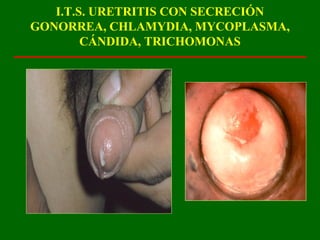 I.T.S. URETRITIS CON SECRECIÓN
GONORREA, CHLAMYDIA, MYCOPLASMA,
        CÁNDIDA, TRICHOMONAS
 