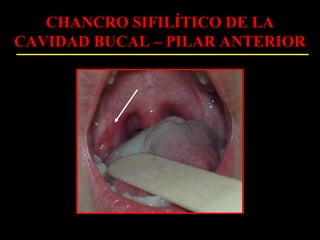 CHANCRO SIFILÍTICO DE LA
CAVIDAD BUCAL – PILAR ANTERIOR
 