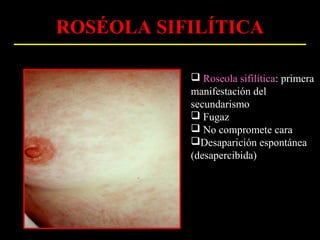 ROSÉOLA SIFILÍTICA

            Roseola sifilítica: primera
           manifestación del
           secundarismo
            Fugaz
            No compromete cara
           Desaparición espontánea
           (desapercibida)
 