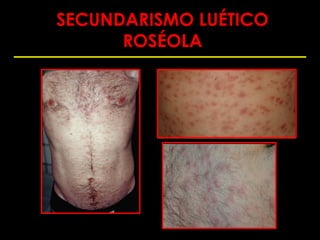 SECUNDARISMO LUÉTICO
      ROSÉOLA
 