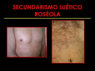 SECUNDARISMO LUÉTICO
      ROSÉOLA
 