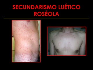 SECUNDARISMO LUÉTICO
      ROSÉOLA
 