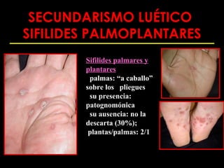 SECUNDARISMO LUÉTICO
SIFILIDES PALMOPLANTARES
        Sifilides palmares y
        plantares
         palmas: “a caballo”
        sobre los pliegues
         su presencia:
        patognomónica
         su ausencia: no la
        descarta (30%);
         plantas/palmas: 2/1
 