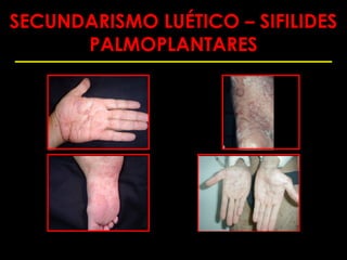 SECUNDARISMO LUÉTICO – SIFILIDES
      PALMOPLANTARES
 