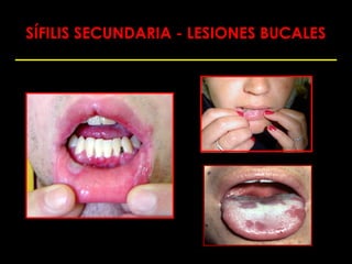 SÍFILIS SECUNDARIA - LESIONES BUCALES
 
