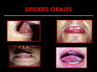 SIFILIDES ORALES
 