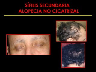 SÍFILIS SECUNDARIA
ALOPECIA NO CICATRIZAL
 