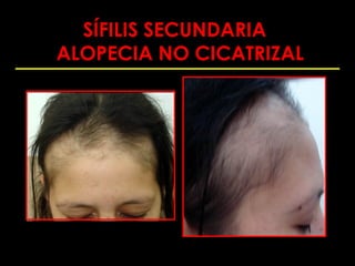 SÍFILIS SECUNDARIA
ALOPECIA NO CICATRIZAL
 