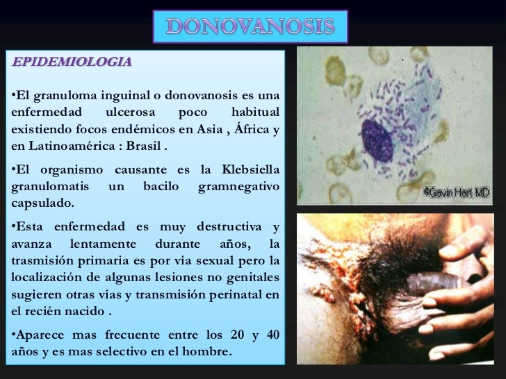 Its chancro granuloma inguinal candida