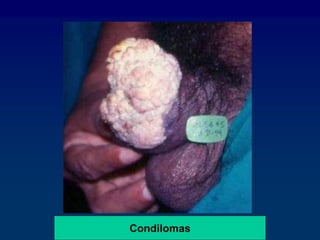 Condilomas
 