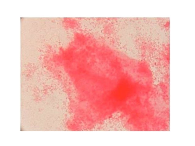 Its uretritis y cervicitis