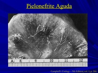 Pielonefrite Aguda Campbell’s Urology – 9th Edition; vol. 1; p. 266. 