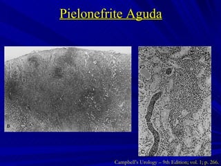 Pielonefrite Aguda Campbell’s Urology – 9th Edition; vol. 1; p. 266. 