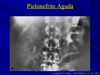 Pielonefrite Aguda Campbell’s Urology – 9th Edition; vol. 1; p. 269. 