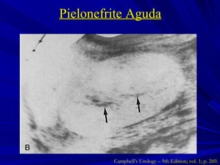 Pielonefrite Aguda Campbell’s Urology – 9th Edition; vol. 1; p. 269. 