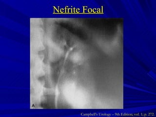 Nefrite Focal Campbell’s Urology – 9th Edition; vol. 1; p. 272. 