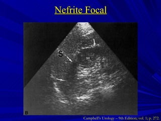Nefrite Focal Campbell’s Urology – 9th Edition; vol. 1; p. 272. 