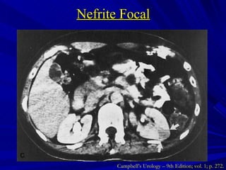 Nefrite Focal Campbell’s Urology – 9th Edition; vol. 1; p. 272. 