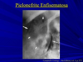Pielonefrite Enfisematosa Campbell’s Urology – 9th Edition; vol. 1; p. 273. 